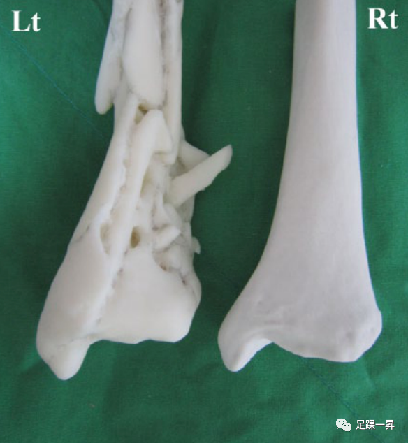 Application of 3D Printing Technology in Complex Tibial Fractures
