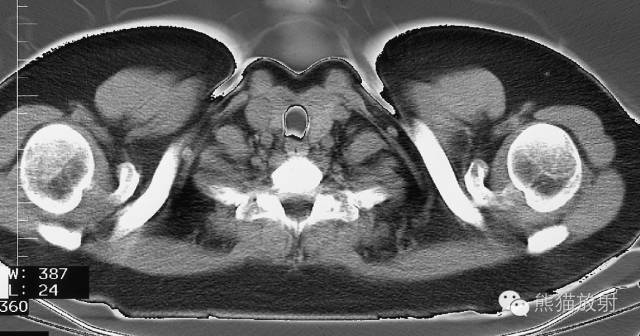 Chest Anatomy | Chest CT Cross-Sectional Anatomy