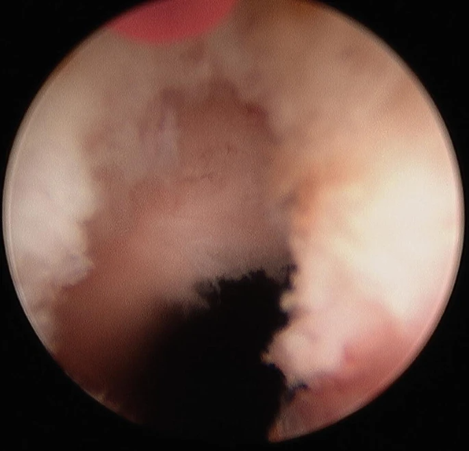 HoLEP Procedure Steps and Techniques