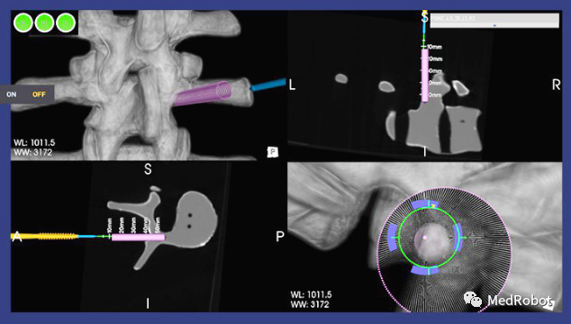 Overview of 5 Orthopedic Navigation and Surgical Robots