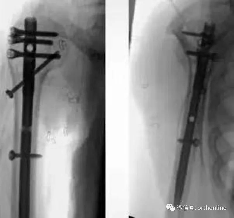Introduction and Resetting Tips for Proximal Humerus Multilock Intramedullary Nail