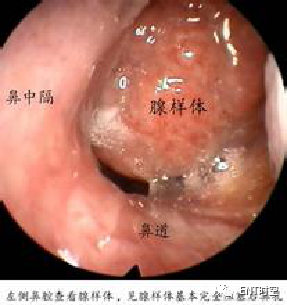 Diagnosis and Treatment of Adenoid Hypertrophy and Complications