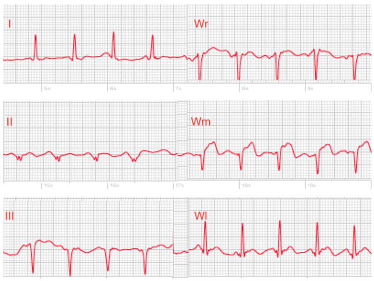 Mastering Smartwatches: Transforming Into An ECG Machine