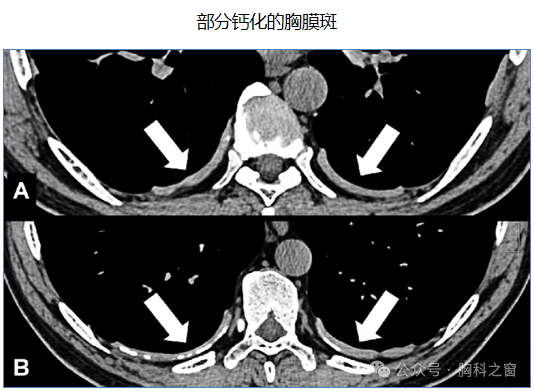 Compilation of Chest Imaging Terminology (IV)