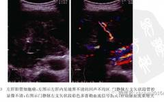 Ultrasound Imaging of Intrahepatic Cholangiocarcinoma