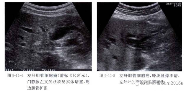 Ultrasound Imaging of Intrahepatic Cholangiocarcinoma