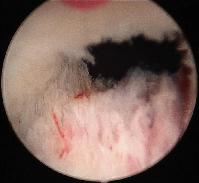 HoLEP Procedure Steps and Techniques
