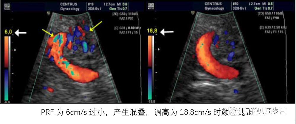 Understanding and Adjusting Parameters of Color Doppler Ultrasound Machines