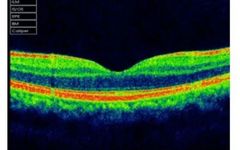 How to Identify Macular Edema in OCT Examination