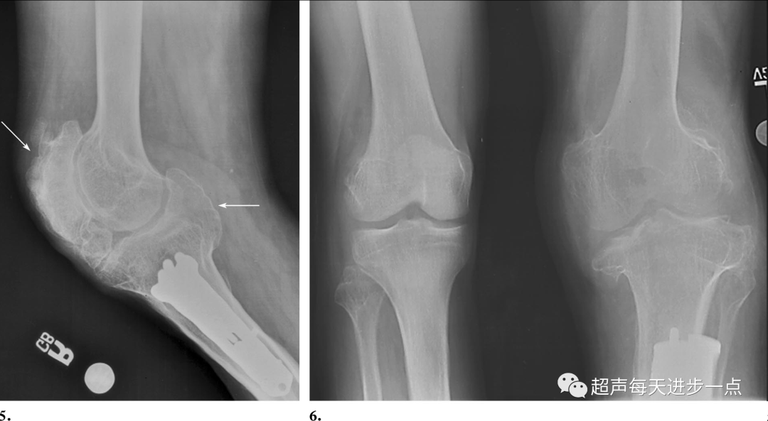 Proteus Syndrome: Characteristics and Diagnosis
