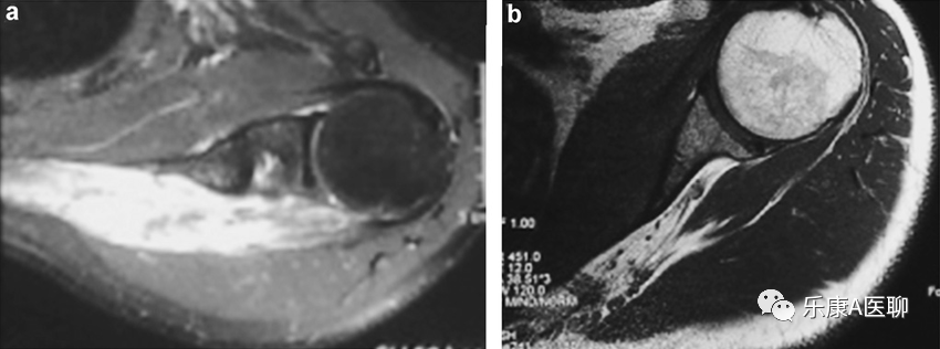 What We Should Know About the Infraspinatus Muscle