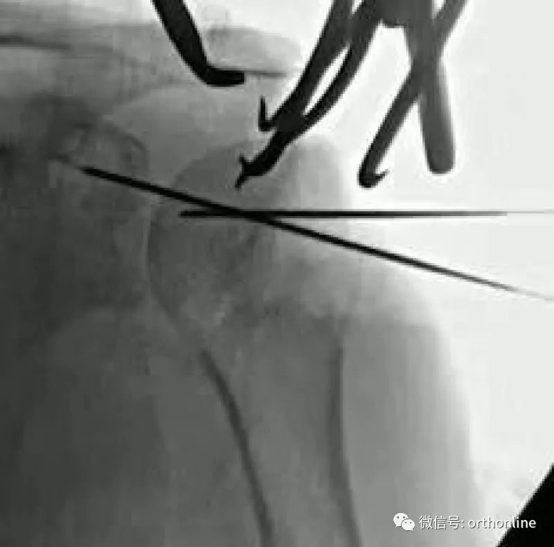Introduction and Resetting Tips for Proximal Humerus Multilock Intramedullary Nail
