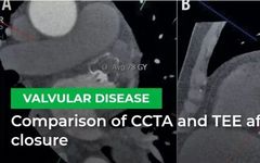 Cardiac CTA as a Replacement for Esophageal Echocardiography After LAAC