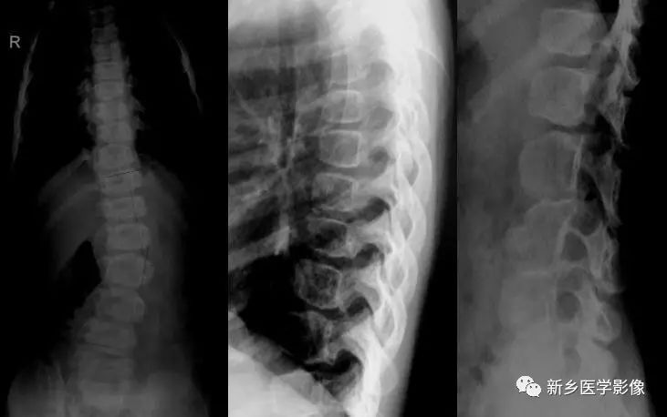 Overview of Proteus Syndrome