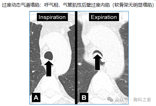 Compilation of Chest Imaging Terminology (IV)