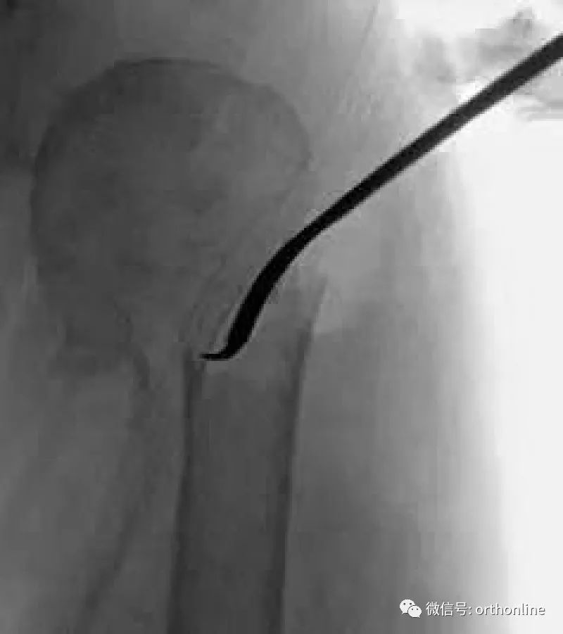 Introduction and Resetting Tips for Proximal Humerus Multilock Intramedullary Nail