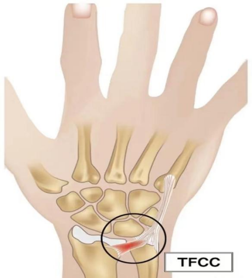 Common Factors for Ulnar-Sided Wrist Pain in Athletes