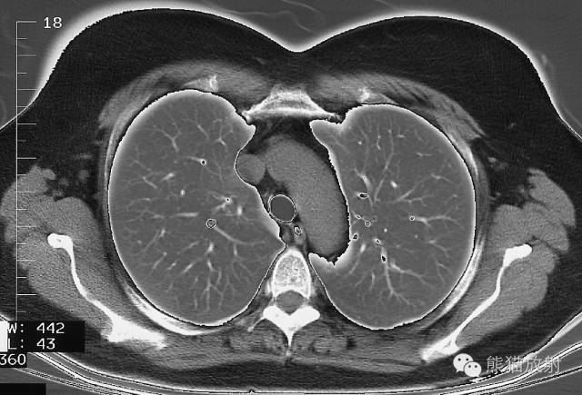 Chest Anatomy | Chest CT Cross-Sectional Anatomy