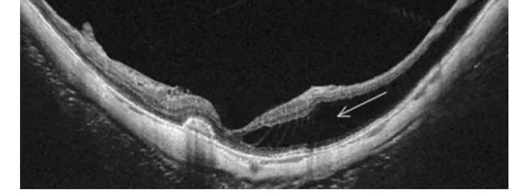 How to Identify Macular Edema in OCT Examination