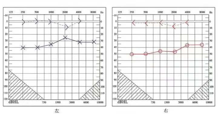 The Past And Present Of Secretory Otitis Media In Children