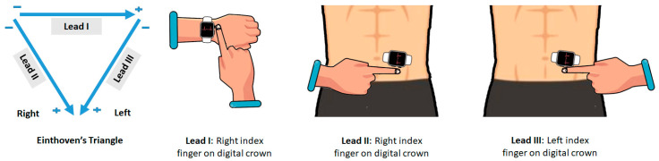 Mastering Smartwatches: Transforming Into An ECG Machine