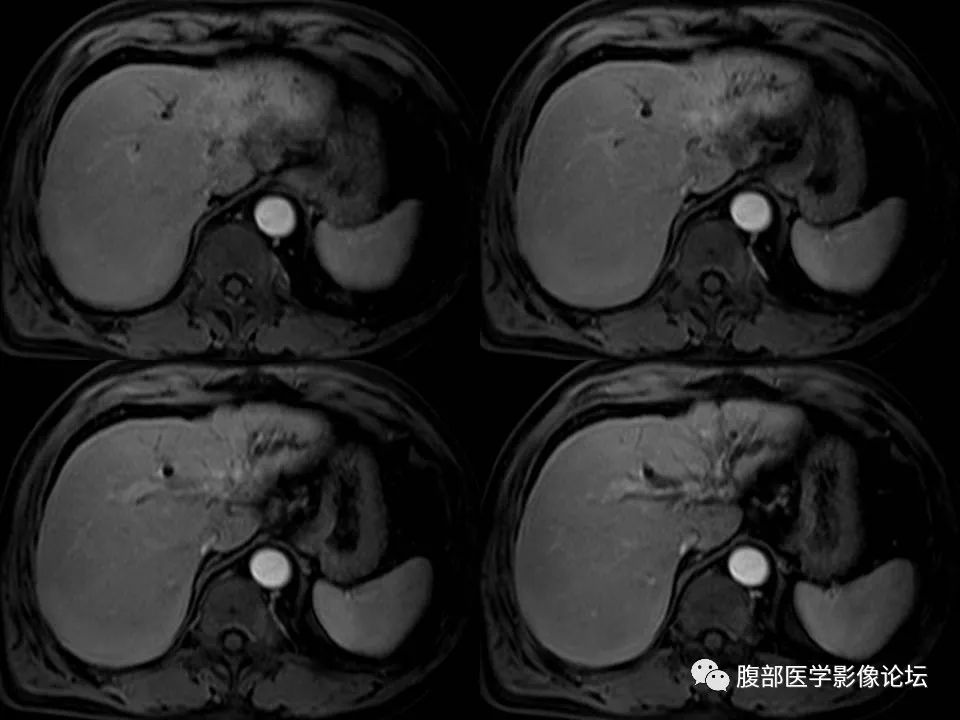 Cholangiocarcinoma: Insights and Clinical Perspectives