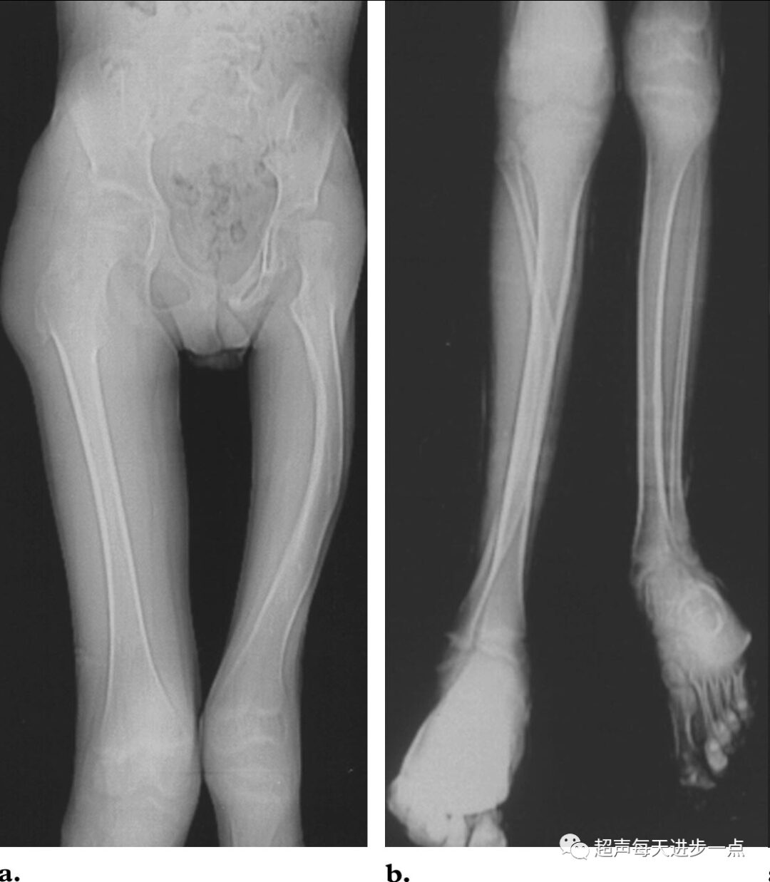 Proteus Syndrome: Characteristics and Diagnosis