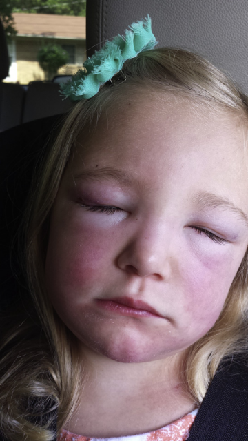 Understanding NXP2 Positive Juvenile Dermatomyositis
