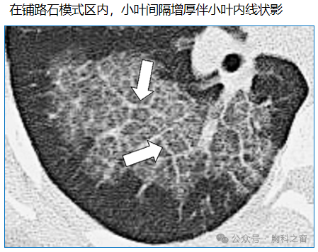 Compilation of Chest Imaging Terminology (IV)