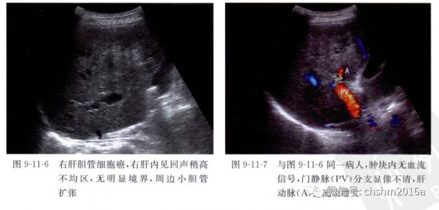 Ultrasound Imaging of Intrahepatic Cholangiocarcinoma