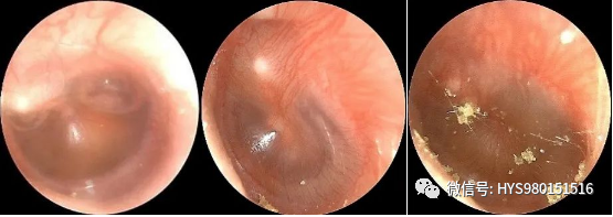 The Past And Present Of Secretory Otitis Media In Children