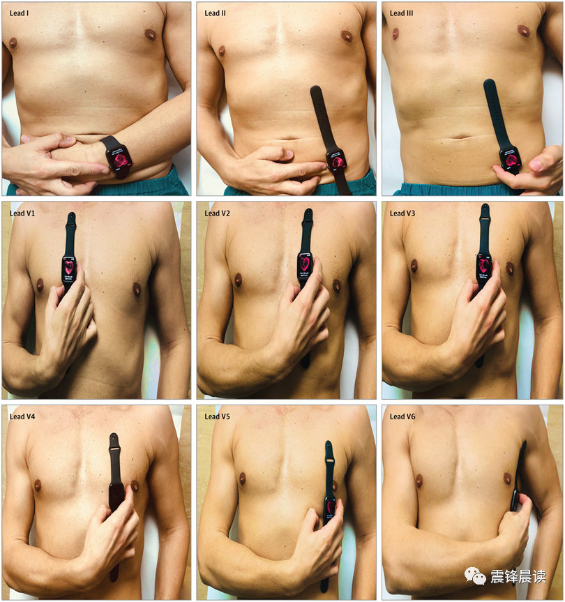 Mastering Smartwatches: Transforming Into An ECG Machine