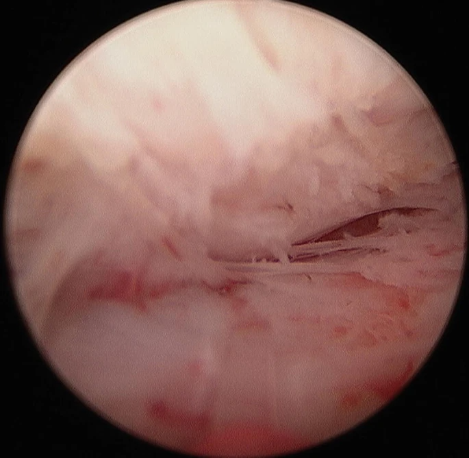 HoLEP Procedure Steps and Techniques