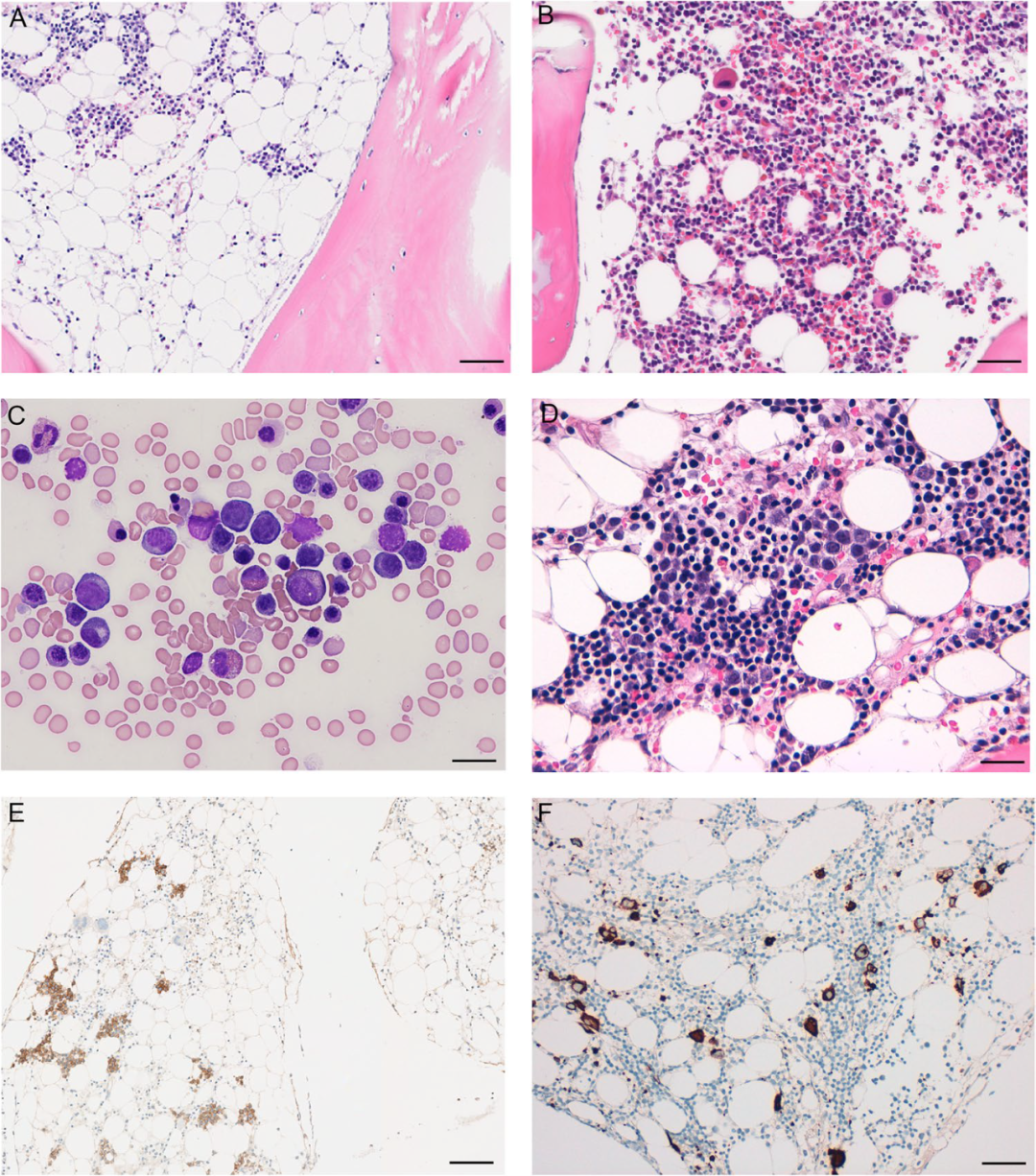 Classification of ICC Pediatric Refractory Cytopenia and MDS