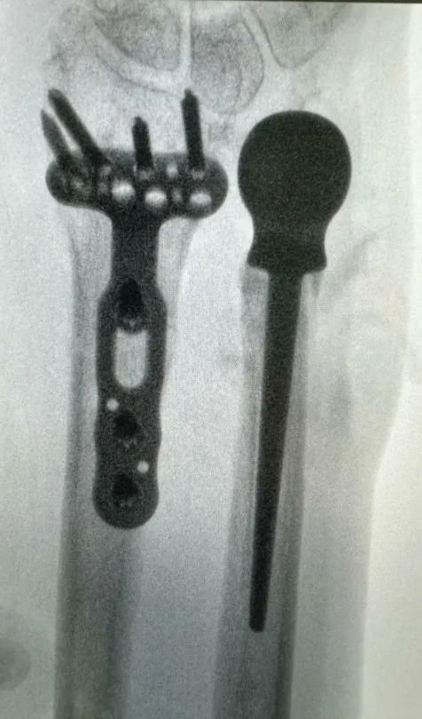 Can 3D Printed Bones Replace Original Ones?