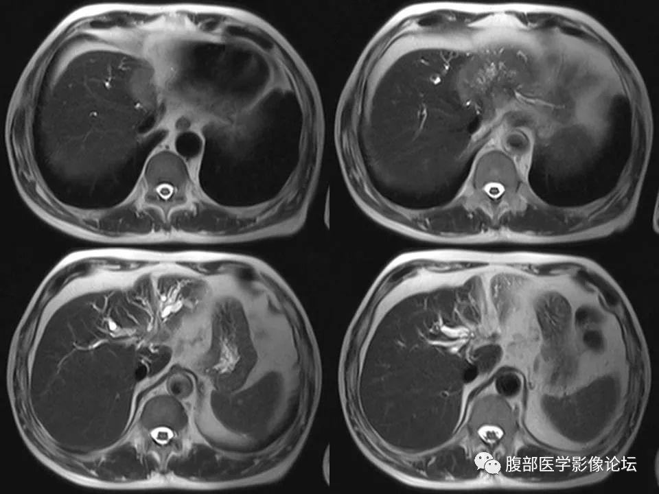 Cholangiocarcinoma: Insights and Clinical Perspectives