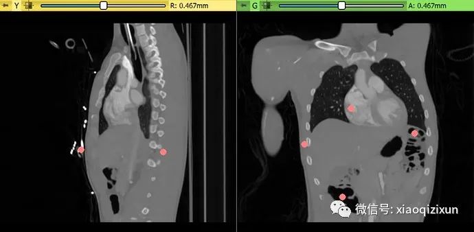 AI-Assisted Segmentation in Medical Imaging: Practical Steps and Case Studies
