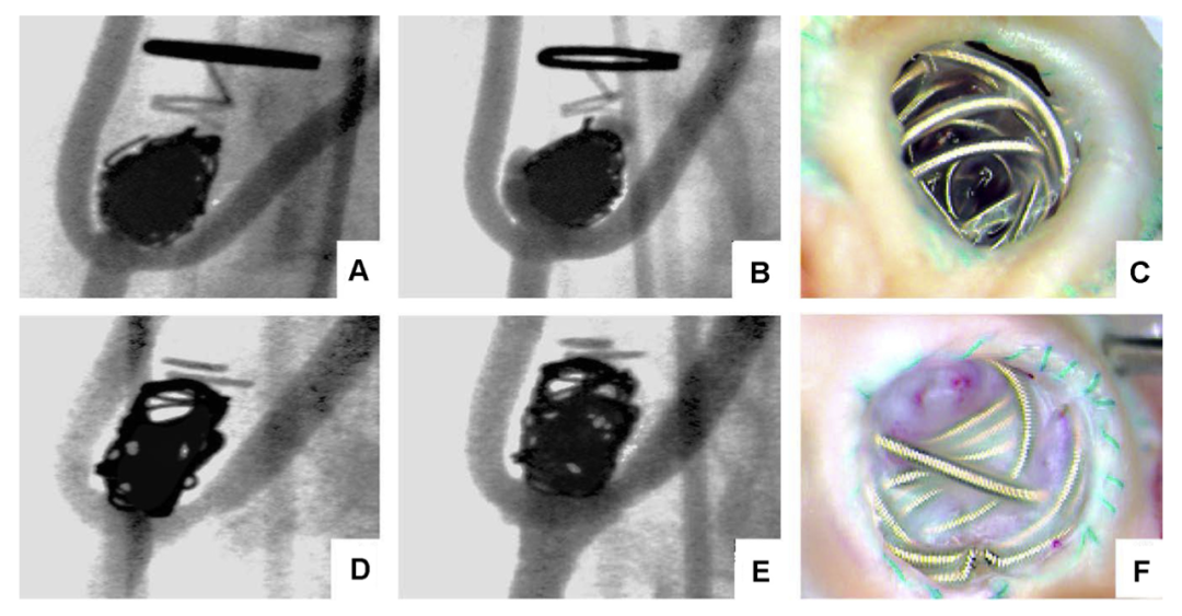 Using Other Stones to Polish Jade: Insights on LAAC Residual Leak Management
