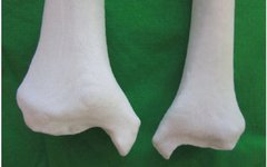 Application of 3D Printing Technology in Complex Tibial Fractures