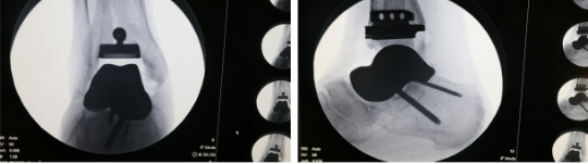 3D Printing Saves Ankle Function in Osteonecrosis