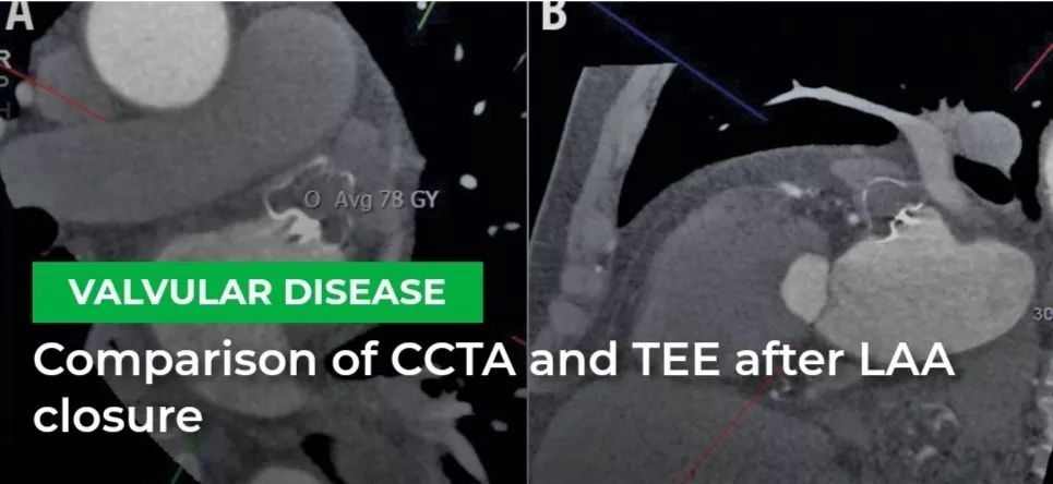 Cardiac CTA as a Replacement for Esophageal Echocardiography After LAAC