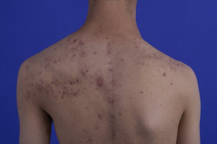 Professor Zhang Jianzhong's Guide To Acne Along Blaschko Lines In Proteus Syndrome