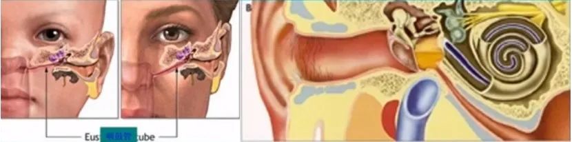 The Past And Present Of Secretory Otitis Media In Children