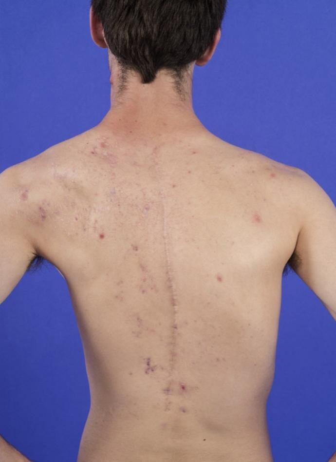 Professor Zhang Jianzhong's Guide To Acne Along Blaschko Lines In Proteus Syndrome