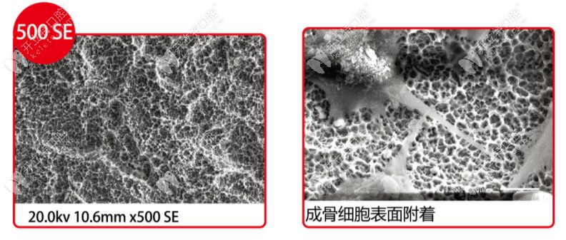 What Grade of Pure Titanium is the Domestic Chuangying Implant?