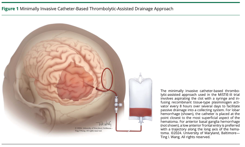 Surgical Management for Primary Intracerebral Hemorrhage