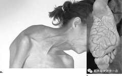 Proteus Syndrome: Characteristics and Diagnosis