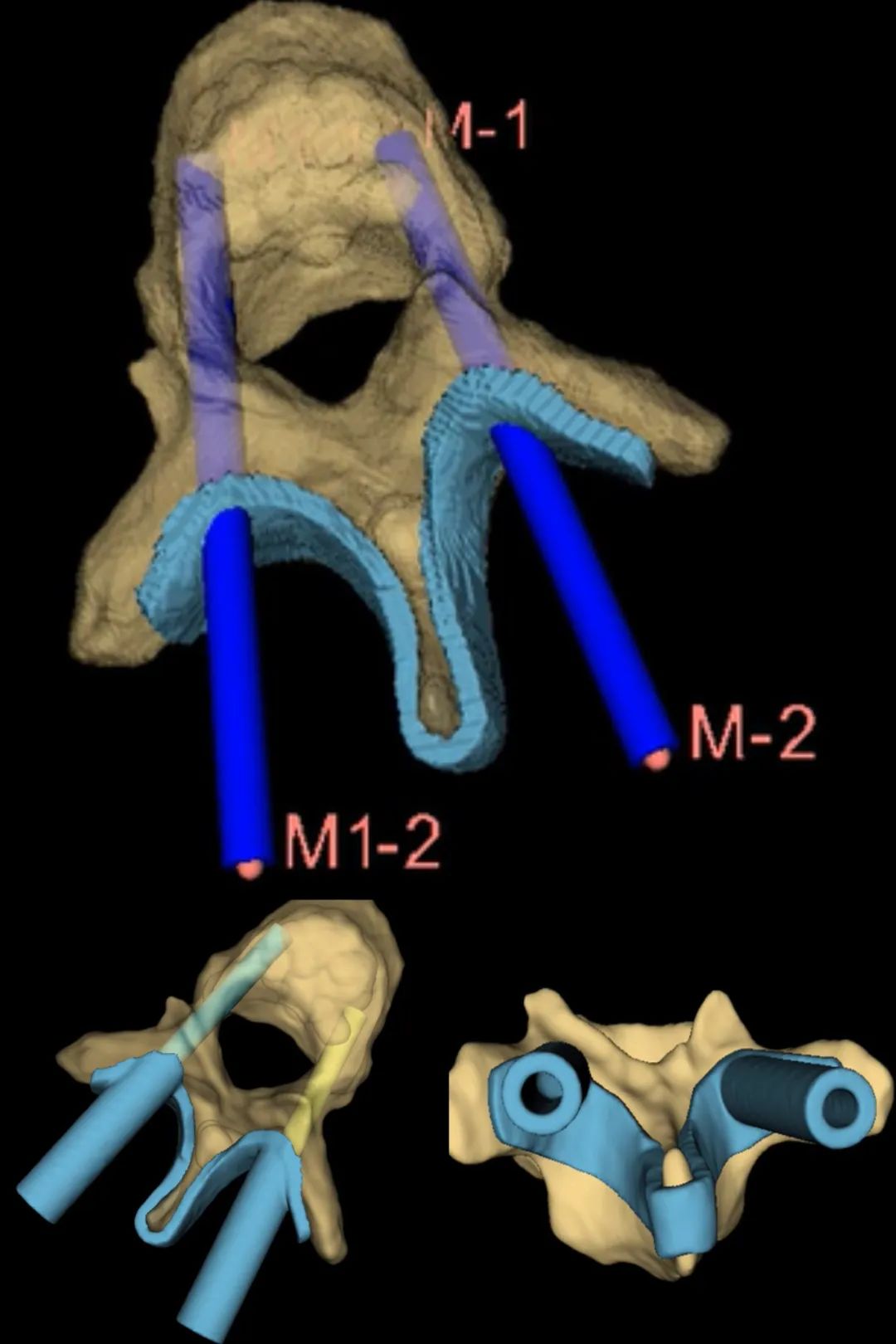 3D Printing Bones: Turning Virtual into Reality