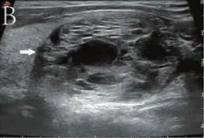 Which Thyroid Nodules Require Surgical Removal? Exploring C-TIRADS Classification
