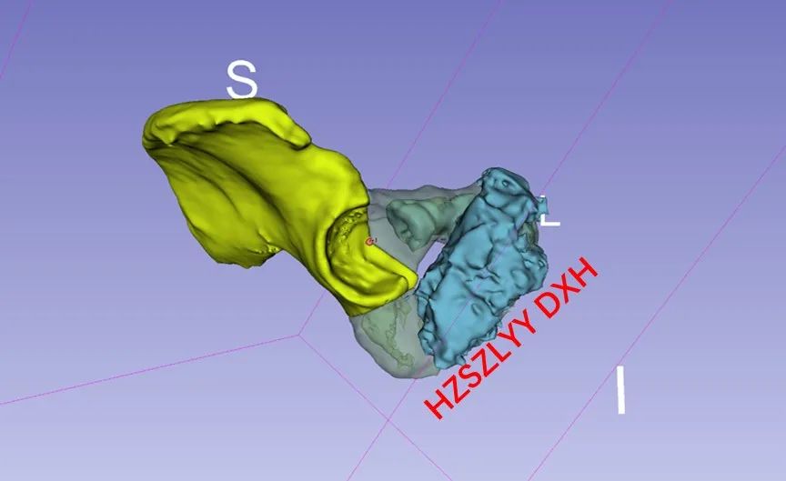 AI and Medical Imaging Fusion Modeling with 3D Printing for Precise Bone Tumor Resection